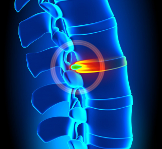 Il problema multidimensionale del mal di schiena